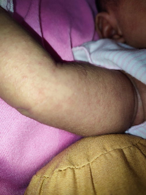 Iritasi ruam bintik-bintik merah