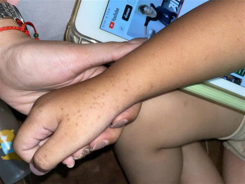 จุดคล้ายๆกระขึ้น