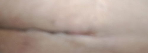 jahitan op secar keluar nanah