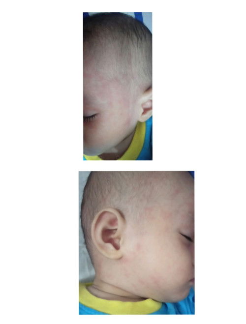 Merah² di muka dan badan setelah demam 2hari