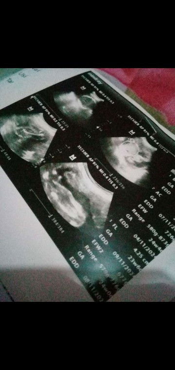 Cara lihat jk jamin di gambar USG itu gimna sih bun..