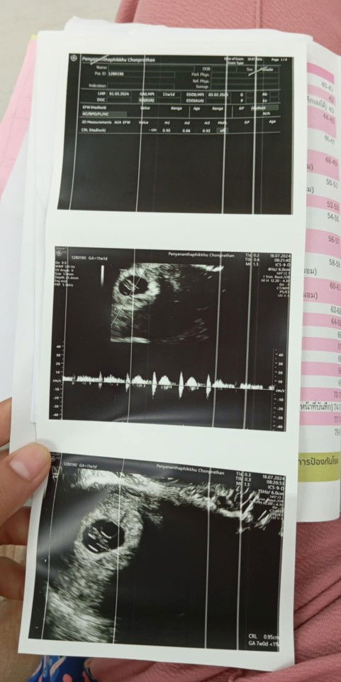อายุครรภ์7วีค
