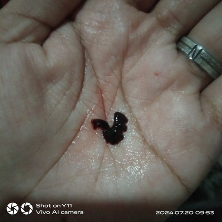 Subchorionic Hemorrhage
