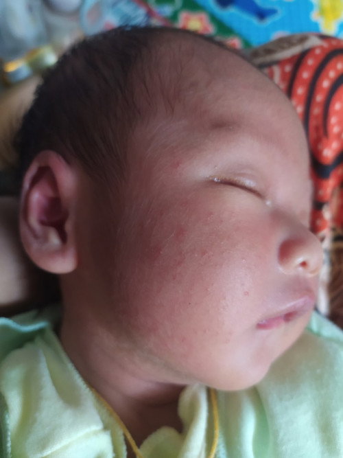 Brruntusan pada bayi