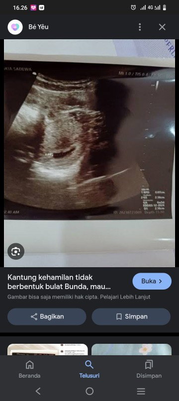 Kantung kehamilan tidak bulat