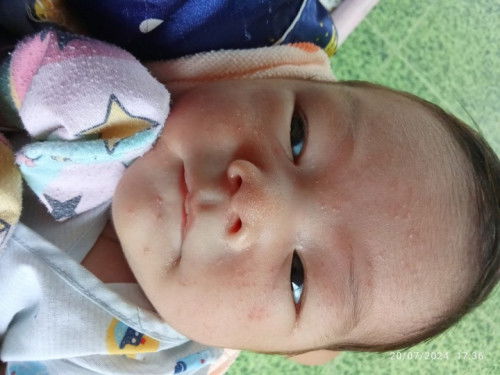 น้องอายุ19วัน เป็นผื่นแบบนี้ปกติไหมคะ ก่อนจะออกโรงบาลหมอฉีดยาปลูกฝีให้เขาบอกจะมีตุ่มขึ้น