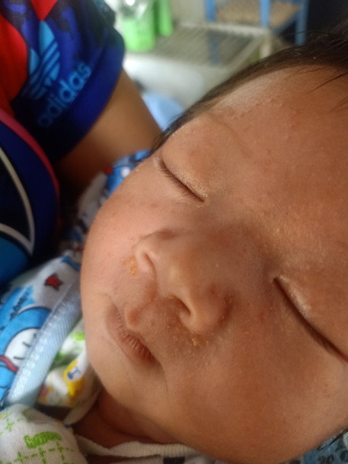 น้องผื่นขึ้นเเบบนี้ เเล้วตรงจมูกเป็นเหลืองๆเกิดจากอะไรครับ