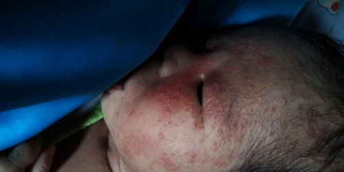 น้องเป็นผื่นแบบนี้อันตรายไหมคะ
แบบนี้ใช่ผื่นแพ้นมไหมคะ