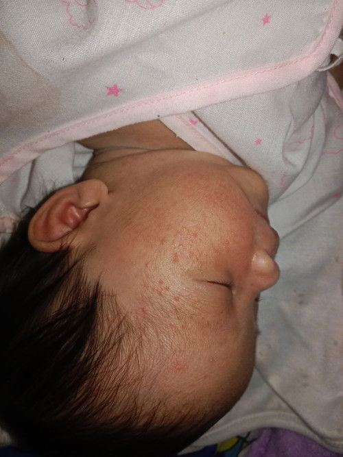 น้องอายุ16วันมีผดผื่นขึ้นแบบนี้ปิดปกติไหมค่ะ