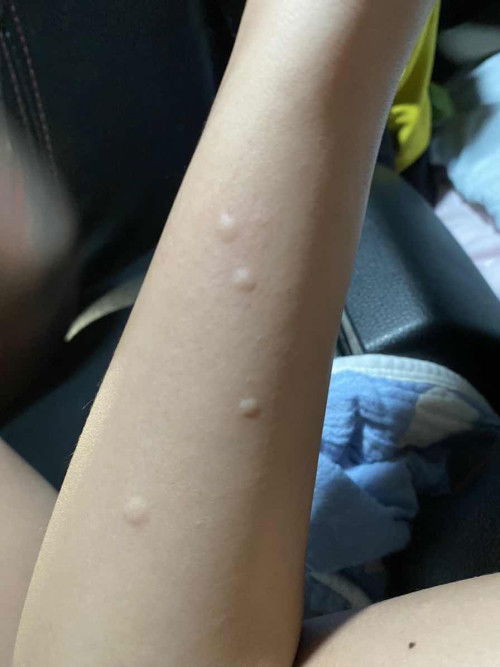 อยากรู้ว่าผื่นแบบนี้คือผื่นอะไรคะ