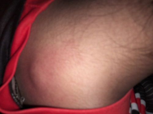 ลูกตะขาบต่อย