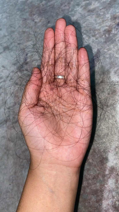 rambut rontok