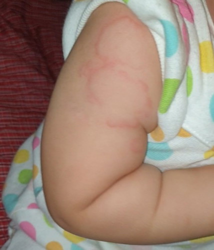 pantal or allergies