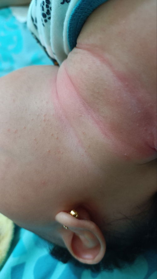 Bu, ini biang keringat ya? Baru pertama kali nih bayiku begini, 5bulan. Obatnya apa ya?