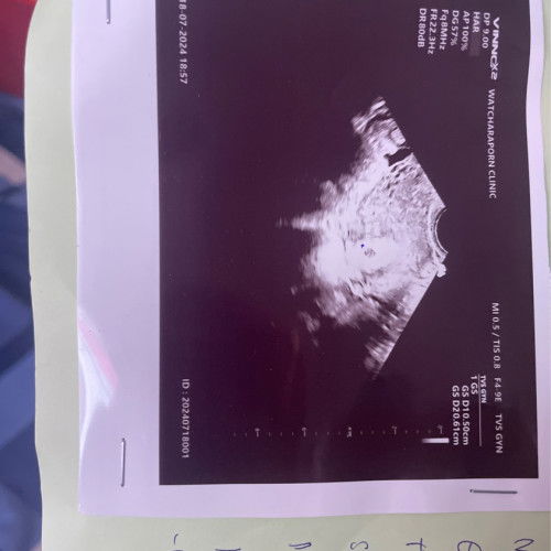 อัลต้ราซาวด์ทางช่องคลอด หมอบอก 4 week. เจอถุงตั้งครรภ์ นัดอีก 2 สัปดาห์ มาดูพัฒนาการ กัลวลกลัวไม่เจอไข่แดงและตัวอ่อน