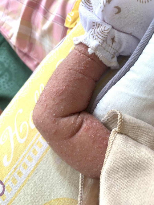 Ruam pada newborn