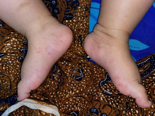 Bintik merah di kaki