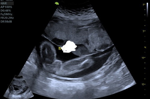 Gender baby