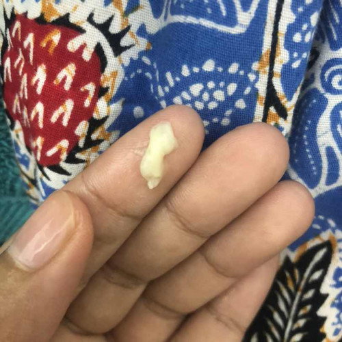 bantu saya , ada keputihan mcm ni normal ke?