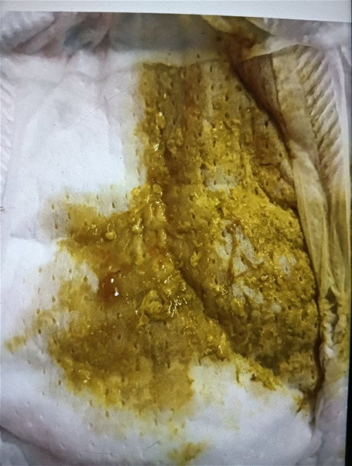 อยากถามว่าลูกถ่ายทีเดียว 5 ครั้งแบบนี้เป็นอันตรายไหมลูกได้ 1 เดือน 10 วันแบบนี้ปกติไมค่ะ