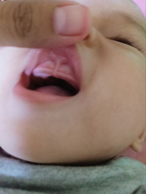 Termasuk lip tie atau bukan?