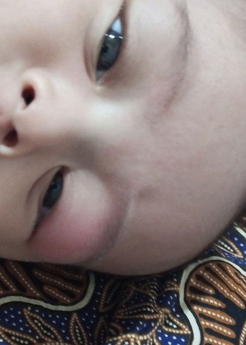 Gatal pada bayi gigitan nyamuk