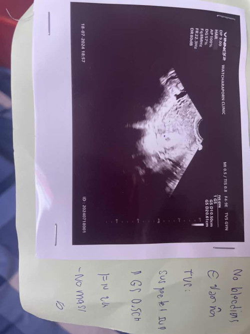 Pcos ค่ะ ตั้งครรภ์ธรรมชาติไม่ได้บำรุง มาเอง กังวล เพราะเห็นว่ามีความเสี่ยงท้องลมคือไข่ไม่สมบรูณ์ และค่อยๆฝ่อ  (ใจไม่ดีเลยค่ะ )