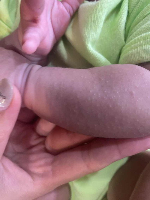 ผื่นตามตัว  หาสาเหตุไม่เจอ