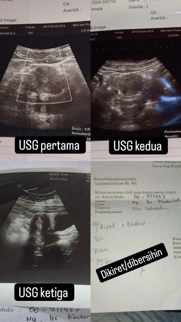 Bunda mAh Tanya pas USG pertama gak Ada kantong nyah Tapi sekarang Ada kantong Tapi Ko Di srh d kret