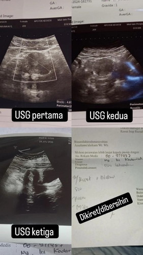 Bunda mAh Tanya pas USG pertama gak Ada kantong nyah Tapi sekarang Ada kantong Tapi Ko Di srh d kret