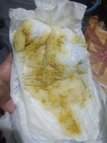 Bund pup bayi kaya gini kenapa ya? Apakah tanda diare? Soalnya bayi nya dalam keadaan batuk