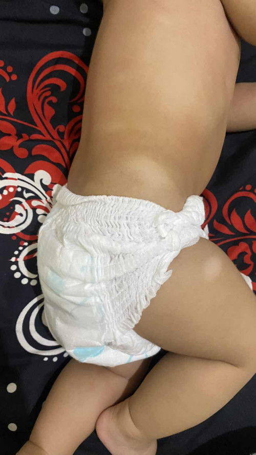 Bercak putih kulit bayi