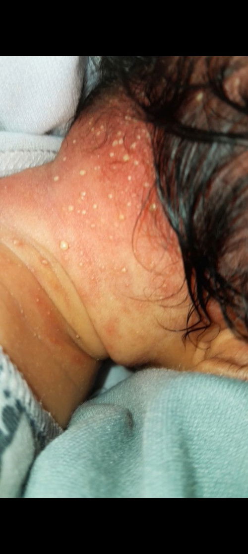 Kulit kepala bayi bintik bernanah