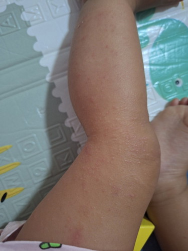 My 1year old baby having a rashes on her skin,Does anyone having this to ur baby before