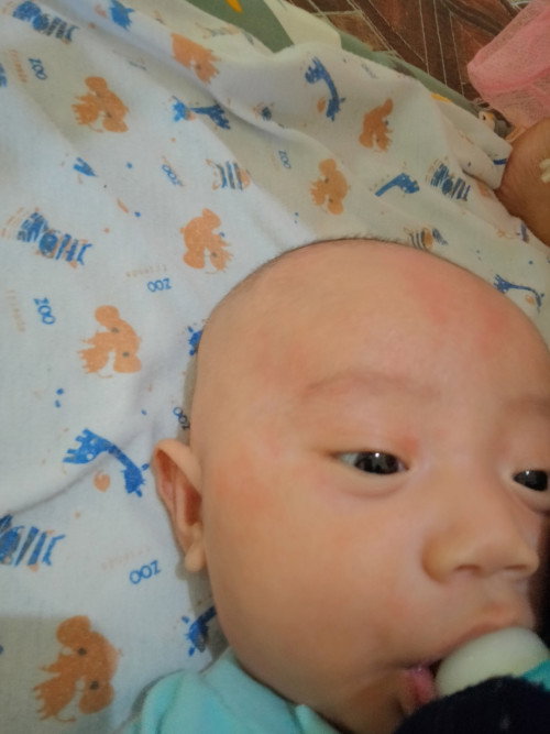 Merah² pada wajah bayi
