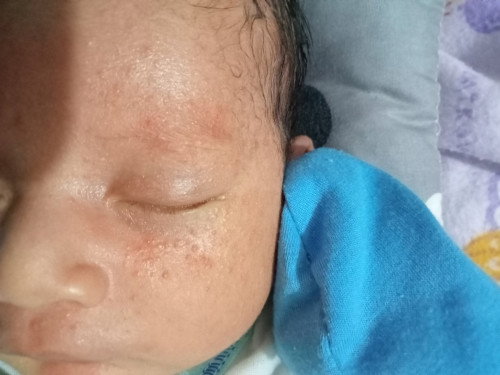 Bintik merah pada bayi
