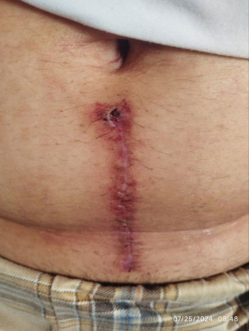 Incision scar