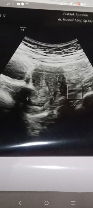 Hasil USG Dokter Menyarankan Kuret