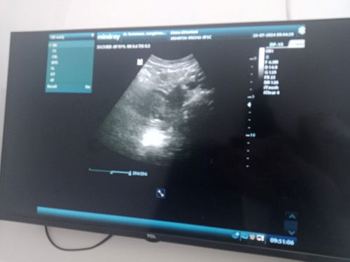 hasil usg hamil 5minggu