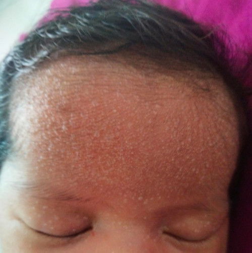 Mau tanya dong Bun anak aku 7 hari jidat nya kaya gini kira² kenapa ya??