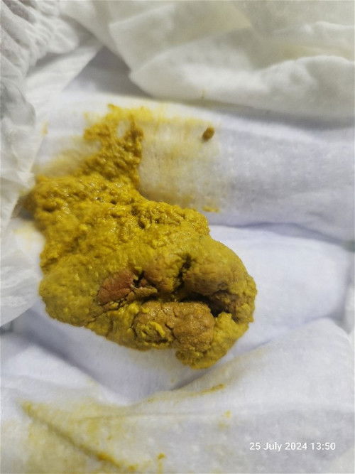 Hi. Adakah texture tahi bayi ni normal?