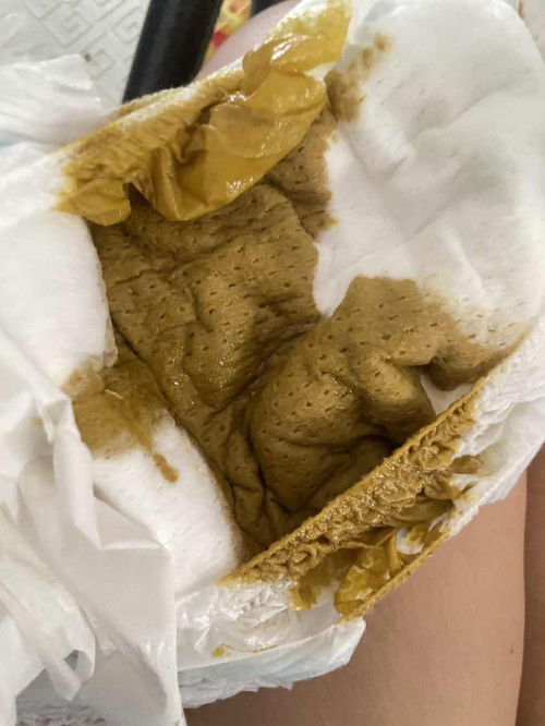 ลักษณะอึลูกเป็นแบบนี้ปกติไหม?