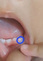 Pertumbuhan Gigi Anak