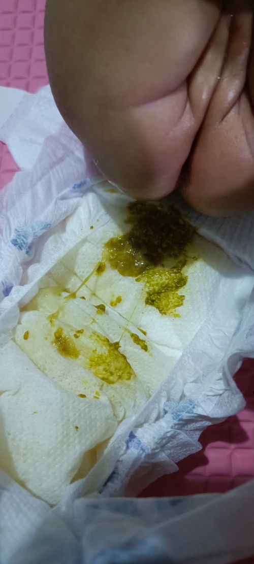 Stool of a 1 month old