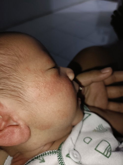 Bintik merah di pipi