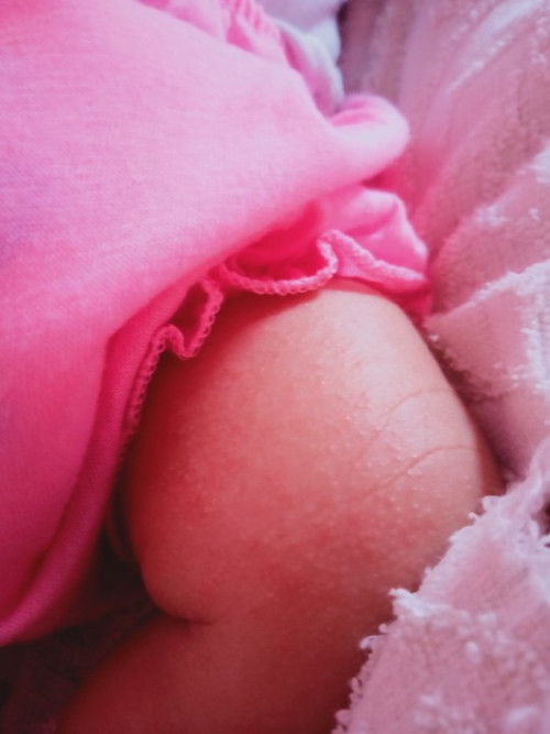 Bintik" pada kulit bayi 1 bulan