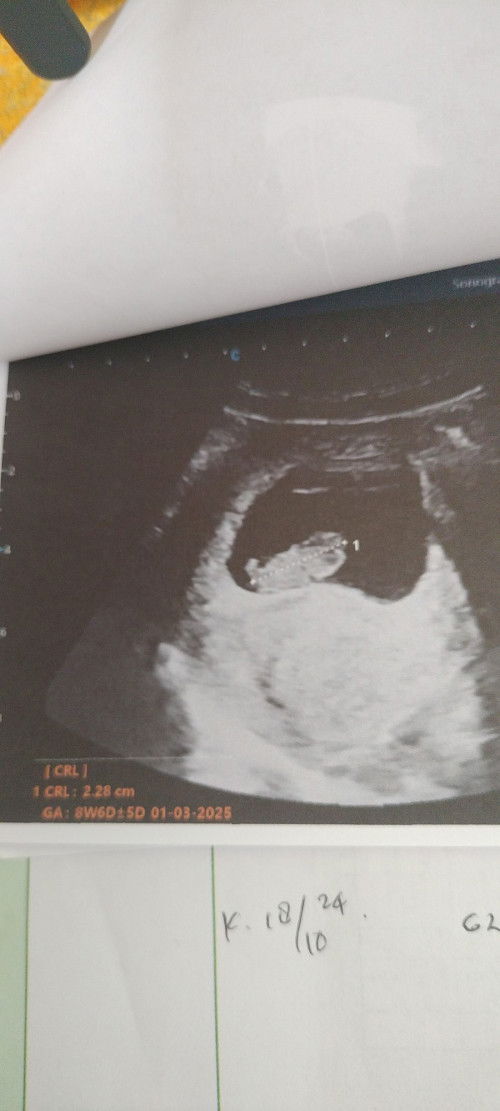 Alhamdulillah hasil Usg 8w5d