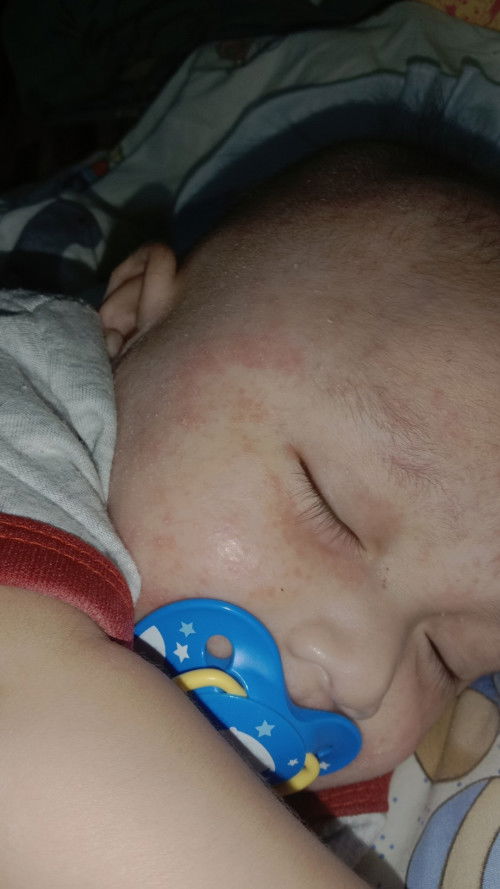 ผดแพ้อะไรใช้ยาตัวไหนได้บ้าง