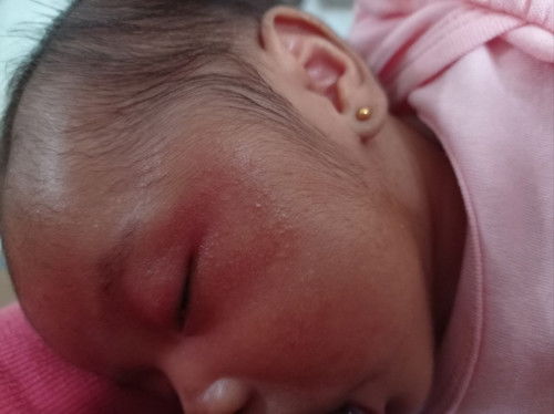 Cara mengatasi ruam di wajah bayi.