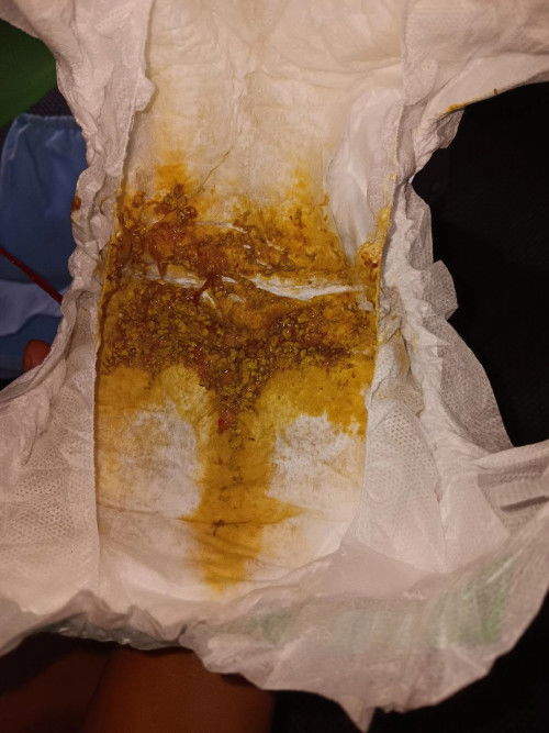 อยากจะสอบถามอ่ะค่ะว่าลูกขี้เป็นแบบนี้ควรไปหาหมอไหมคะ